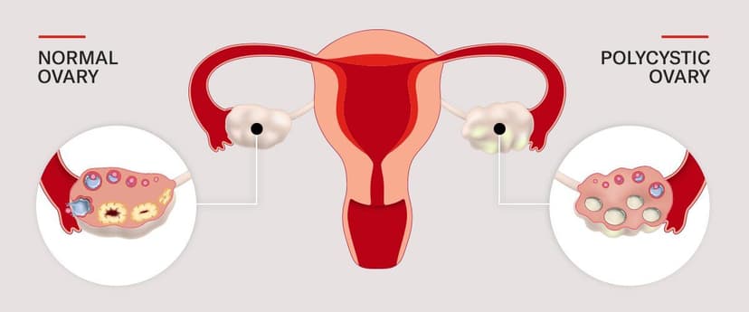 PCOS: Causes, Symptoms, and Diagnostic Tests Explained